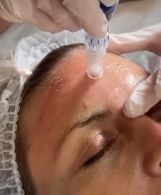 Skin Pen, Microneedling